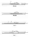 Fig. 04 - DUAL PURPOSE BALLOON CATHETERS