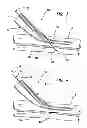 Fig. 03 - Systems for creating arteriovenous (AV) fistulas