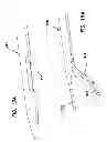 Fig. 10 - Systems for creating arteriovenous (AV) fistulas