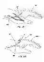 Fig. 13 - Systems for creating arteriovenous (AV) fistulas