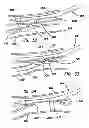 Fig. 17 - Systems for creating arteriovenous (AV) fistulas