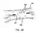 Fig. 18 - Systems for creating arteriovenous (AV) fistulas