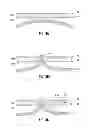 Fig. 03 - Hernia repair system