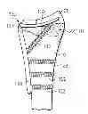 Fig. 01 - System for treating bone fractures