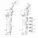 Fig. 22 - System for treating bone fractures