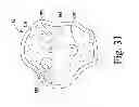 Fig. 16 - Method for surgically implanting a prosthetic patella component