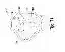 Fig. 16 - Patella drill guide and trial surgical instrument having an alignment bore formed therein and method of using the same