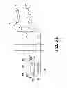 Fig. 17 - Patella drill guide and trial surgical instrument