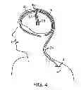 Fig. 04 - MICRO-ELECTRODE RECORDING-GUIDED IMPLANTATION OF DIRECTIONAL LEADS