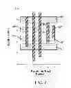Fig. 06 - MICRO-ELECTRODE RECORDING-GUIDED IMPLANTATION OF DIRECTIONAL LEADS