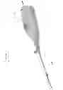 Fig. 02 - Clot removal device for deep vein thrombosis