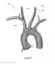 Fig. 03 - EMBOLISM PROTECTION DEVICE
