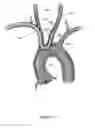 Fig. 04 - EMBOLISM PROTECTION DEVICE