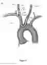 Fig. 06 - EMBOLISM PROTECTION DEVICE