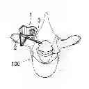 Fig. 01 - Vertebral osteosynthesis equipment