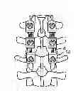 Fig. 01 - Spinal Stabilization Device