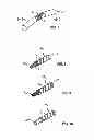 Fig. 05 - Spinal Stabilization Device