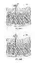 Fig. 17 - Spinal Stabilization Device