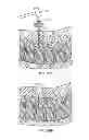 Fig. 19 - Spinal Stabilization Device