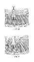 Fig. 23 - Spinal Stabilization Device