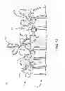 Fig. 07 - Spinal correction system and method