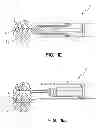 Fig. 03 - Bone fixation tool
