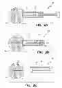 Fig. 04 - Bone fixation tool