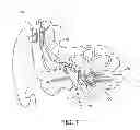 Fig. 02 - COCHLEAR IMPLANT HEARING INSTRUMENT