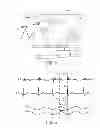 Fig. 04 - Device for assessment and therapy of temporal ventricular desynchronization
