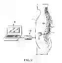 Fig. 03 - Method for treating depression by indirectly stimulating raphe nuclei
