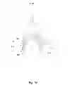 Fig. 06 - Pinch to open cuff electrode