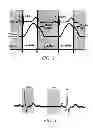 Fig. 06 - Diastolic coronary stent deployment system for precise bifurcation lesion stenting