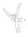 Fig. 02 - Vascular stenting for aneurysms