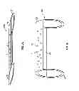 Fig. 03 - Vascular stenting for aneurysms