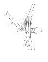 Fig. 07 - Vascular stenting for aneurysms