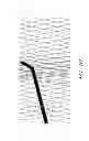 Fig. 25 - Vascular stenting for aneurysms