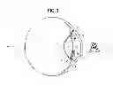 Fig. 04 - INTRAOCULAR LENS AND METHOD