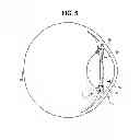 Fig. 06 - INTRAOCULAR LENS AND METHOD