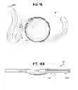 Fig. 11 - INTRAOCULAR LENS AND METHOD
