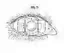 Fig. 22 - INTRAOCULAR LENS AND METHOD