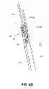 Fig. 09 - Graft fixation device