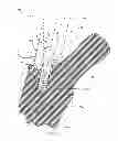 Fig. 07 - Femoral prosthesis with insertion/extraction feature