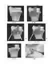 Fig. 22 - Orthopaedic implants