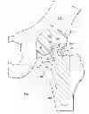 Fig. 02 - Joint Prosthesis with Polymeric Articulation Interface