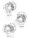 Fig. 02 - Method of uniform crimping and expansion of medical devices