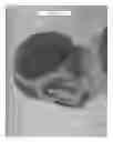 Fig. 56 - Interface comprising a rolling nasal bridge portion