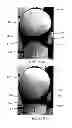Fig. 59 - Interface comprising a rolling nasal bridge portion