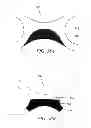 Fig. 60 - Interface comprising a rolling nasal bridge portion