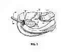 Fig. 05 - Structure containing wound treatment material