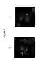 Fig. 05 - Use of spironolactone-based composition that exhibits an inhibitory action on T-lymphocyte activation which is useful for preventing and/or treating multiple sclerosis